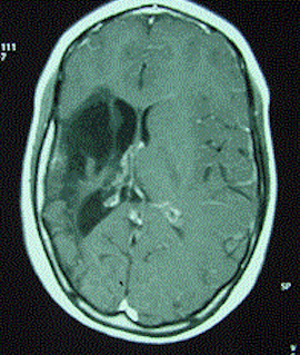 IRM, séquelle d'AVC, source https://upload.wikimedia.org/wikipedia/commons/1/1d/Figure_1_-_Coupes_axiales_d%E2%80%99IRM_c%C3%A9r%C3%A9brale_illustrant_les_4_groupes_%C3%A9tiologiques.gif