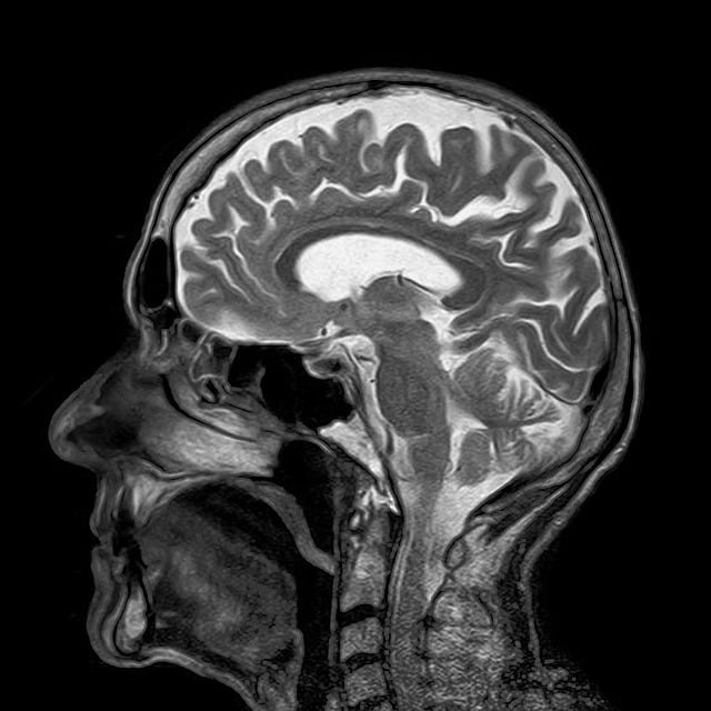 IRM cérébrale, source https://pixabay.com/fr/illustrations/irm-résonance-magnétique-roentgen-782459/