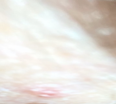 arcinome baso cellulaire (CBC)