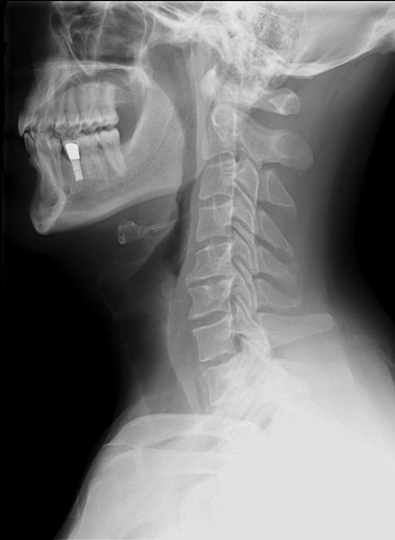 radiographie cervicale, source https://commons.wikimedia.org/wiki/File:Cervical_Xray_Lateral_View.jpg