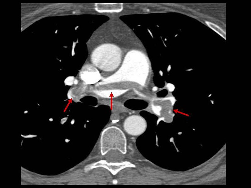 embolie pulmonaire, source https://commons.wikimedia.org/wiki/File:Embolie_CT.jpg